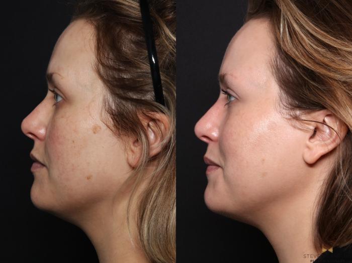 Before & After Sciton Laser Case 665 Left Side View in Fort Worth & Arlington, Texas