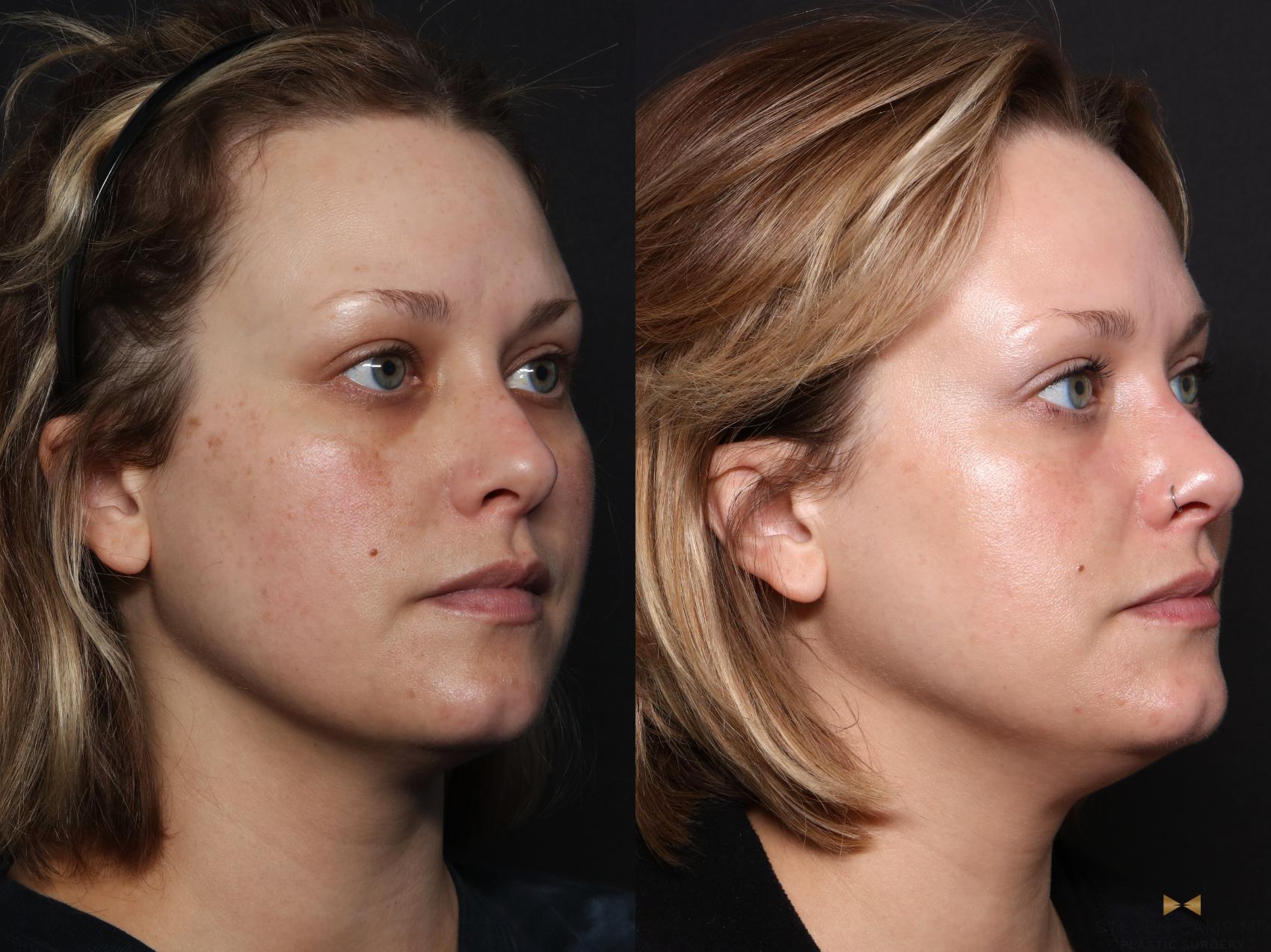 Before & After Sciton Laser Case 665 Right Oblique View in Fort Worth & Arlington, Texas