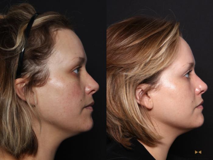 Before & After Sciton Laser Case 665 Right Side View in Fort Worth & Arlington, Texas