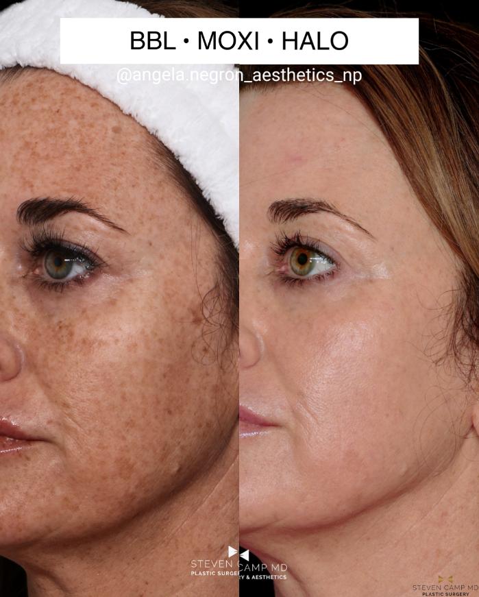 Before & After Sciton Laser Case 711 Left Oblique - Close Up View in Fort Worth & Arlington, Texas