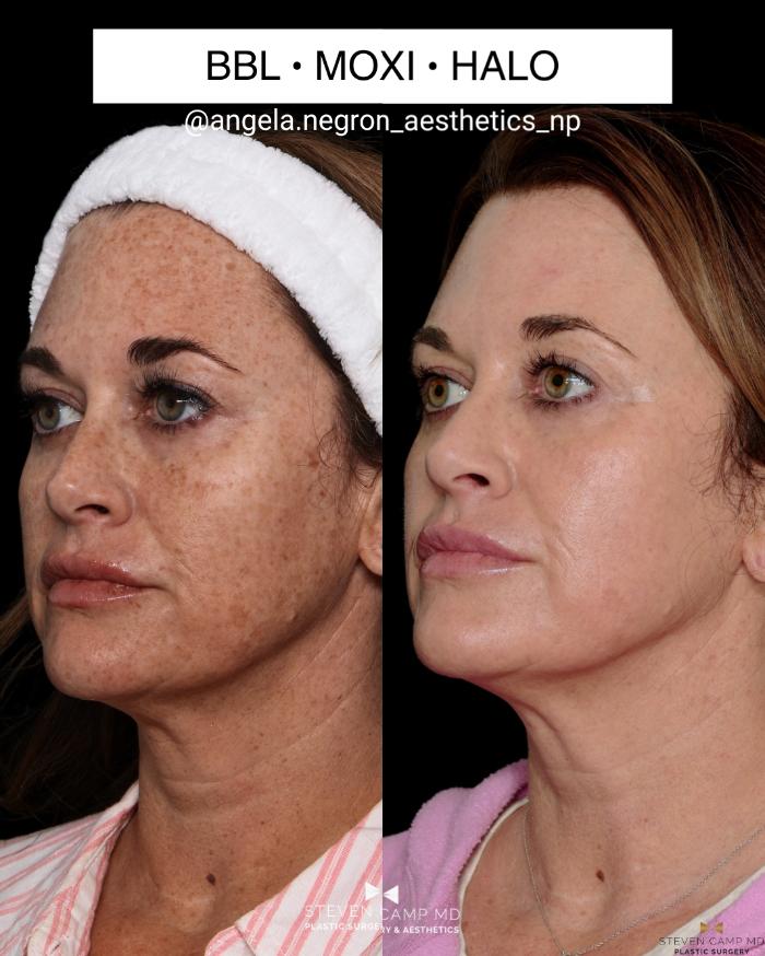Before & After Sciton Laser Case 711 Left Oblique View in Fort Worth & Arlington, Texas