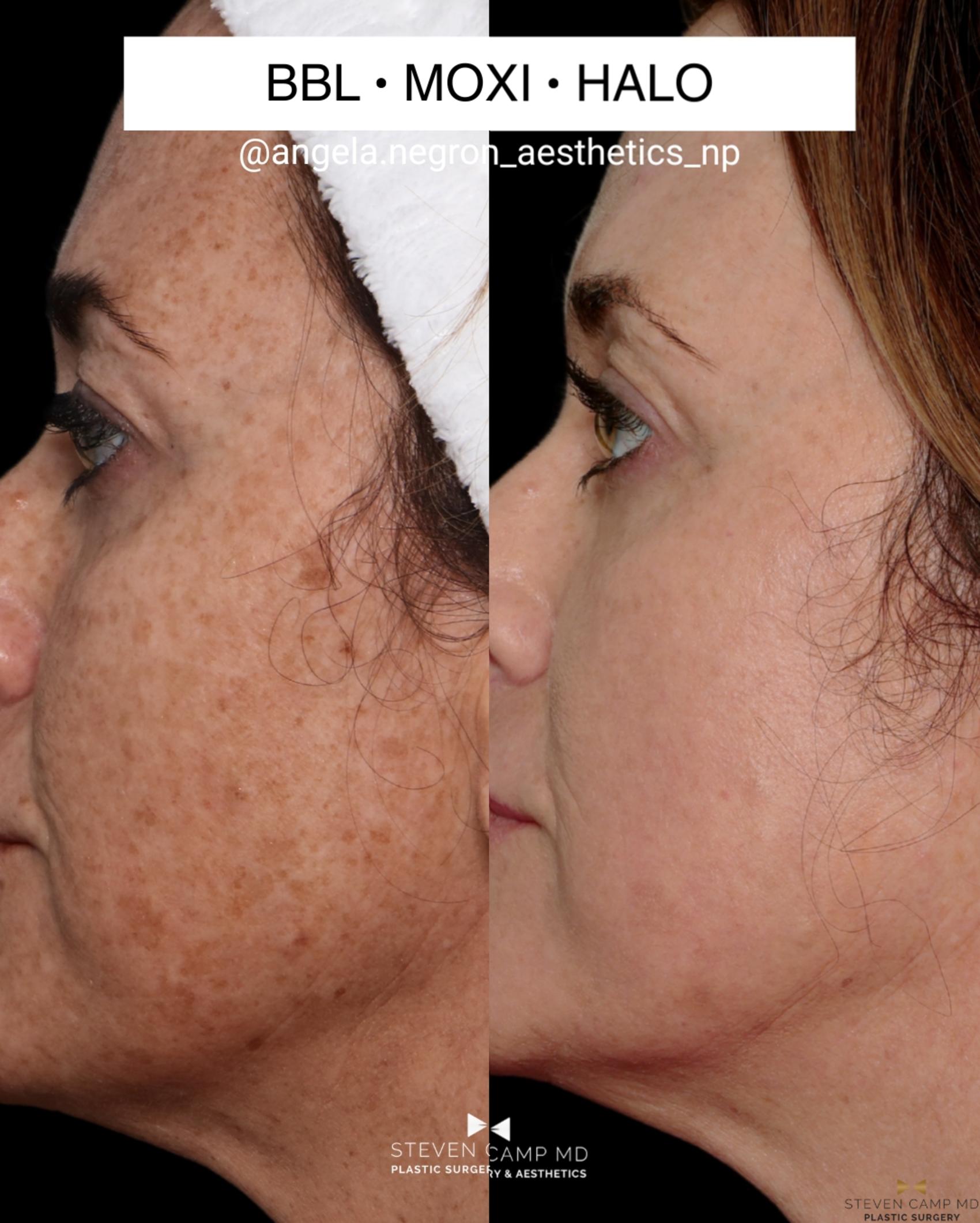 Before & After Sciton Laser Case 711 Left Side - Close Up View in Fort Worth & Arlington, Texas
