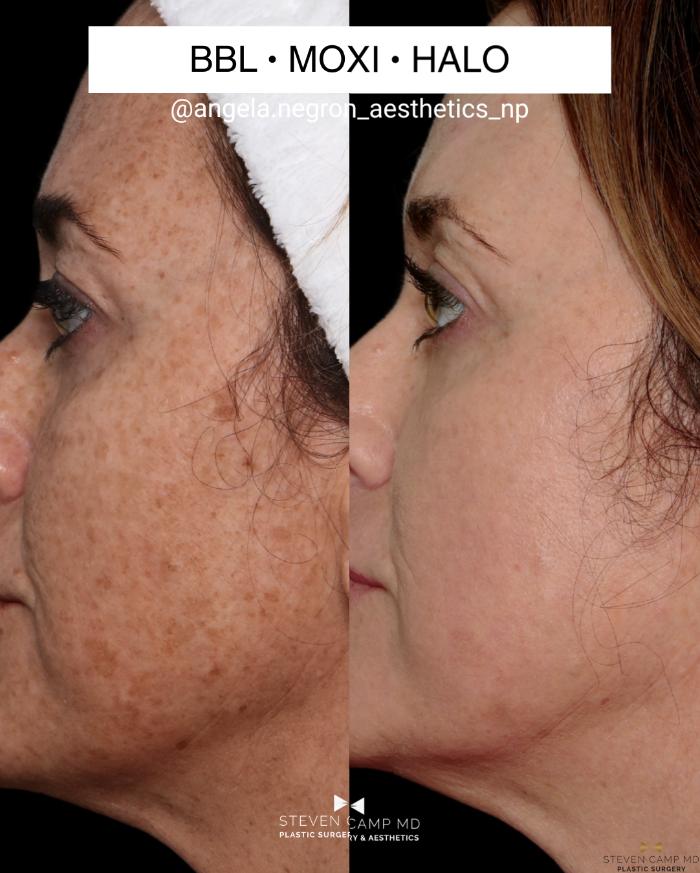 Before & After Sciton Laser Case 711 Left Side - Close Up View in Fort Worth & Arlington, Texas