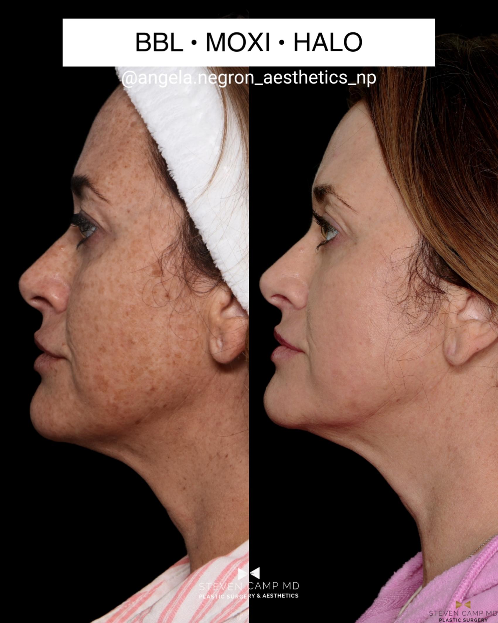 Before & After Sciton Laser Case 711 Left Side View in Fort Worth & Arlington, Texas
