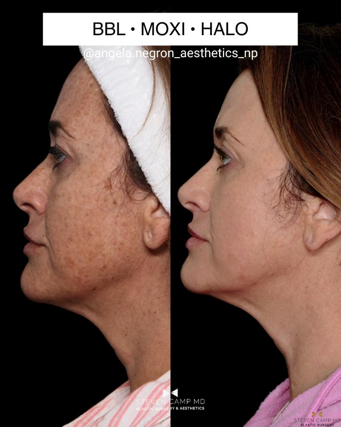 Before & After Sciton Laser Case 711 Left Side View in Fort Worth & Arlington, Texas