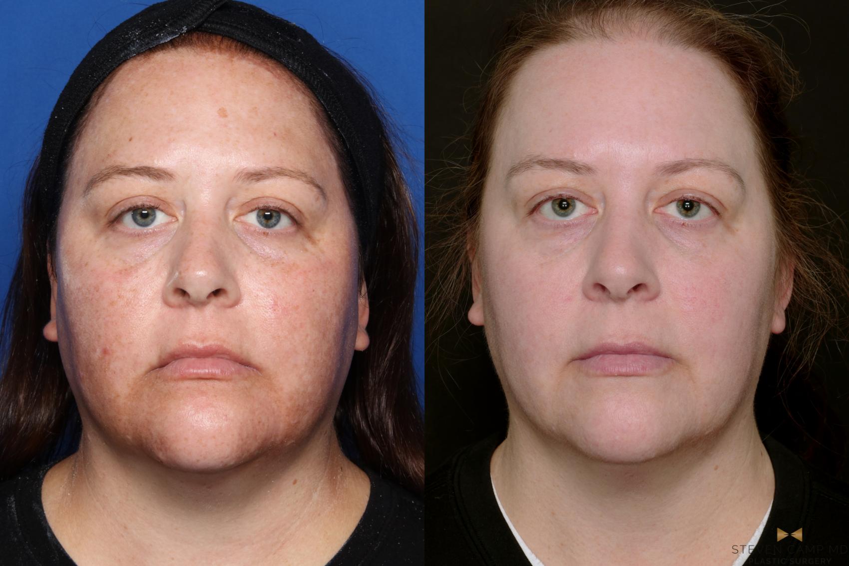 Lasers with Melasma