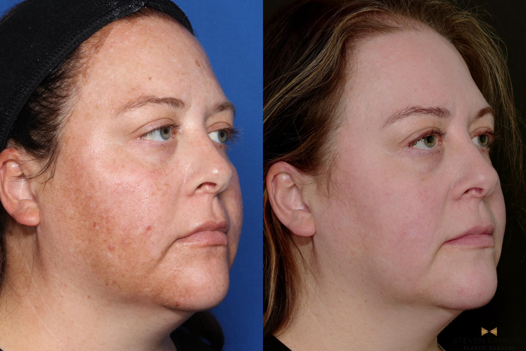 Lasers with Melasma