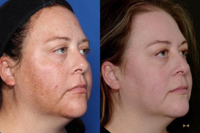 Lasers with Melasma