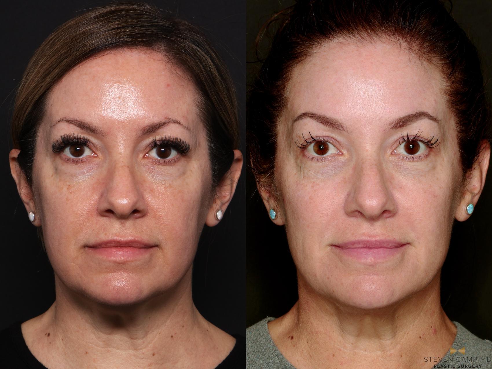 Before & After Sciton Laser Case 744 Front View in Fort Worth & Arlington, Texas
