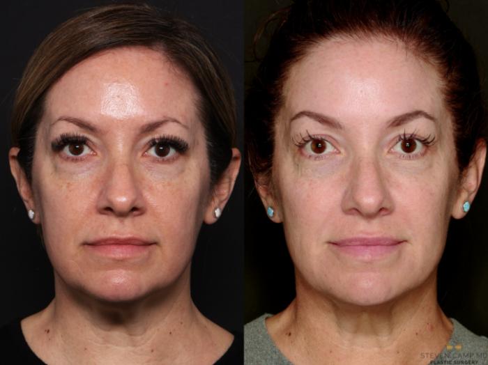 Before & After Sciton Laser Case 744 Front View in Fort Worth & Arlington, Texas