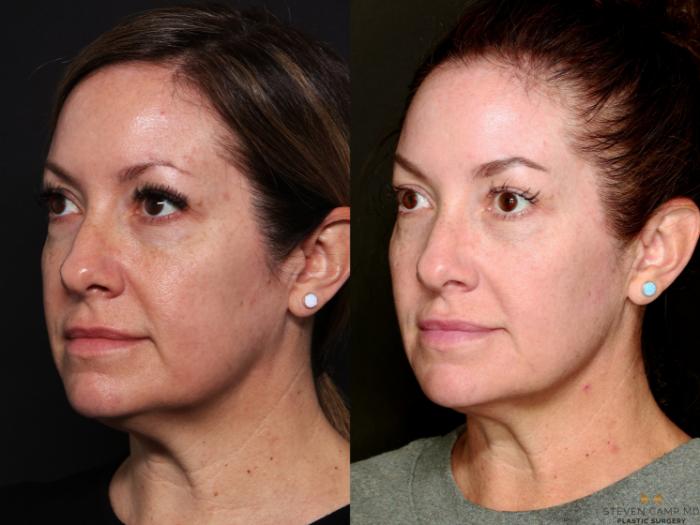 Before & After Sciton Laser Case 744 Left Oblique View in Fort Worth & Arlington, Texas