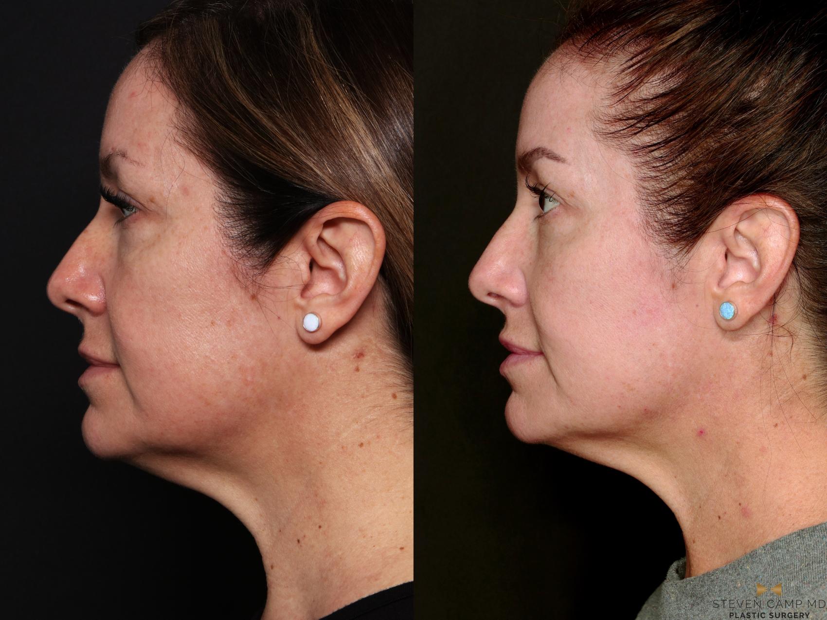 Before & After Sciton Laser Case 744 Left Side View in Fort Worth & Arlington, Texas