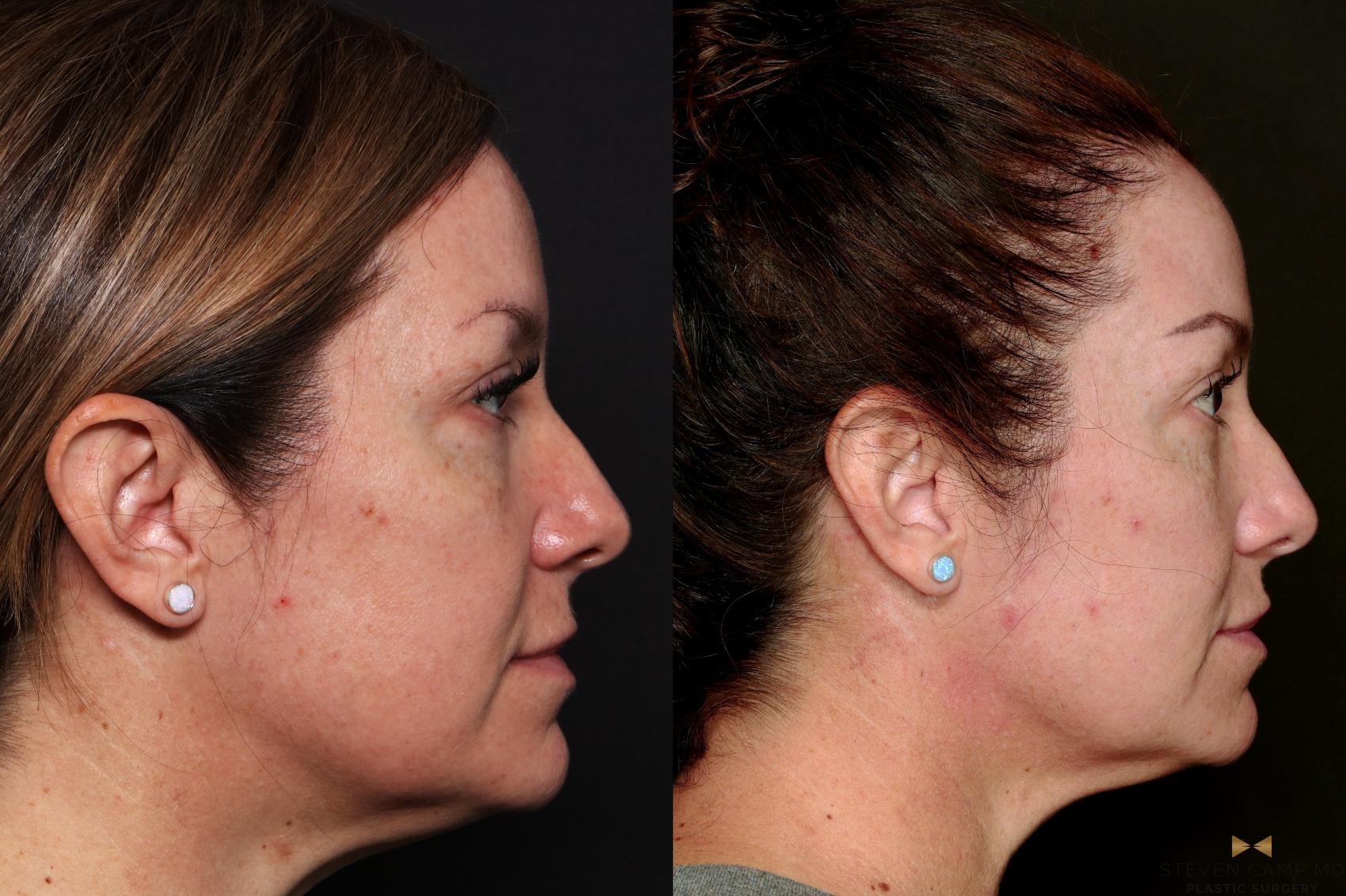Before & After Sciton Laser Case 744 Right Side View in Fort Worth & Arlington, Texas