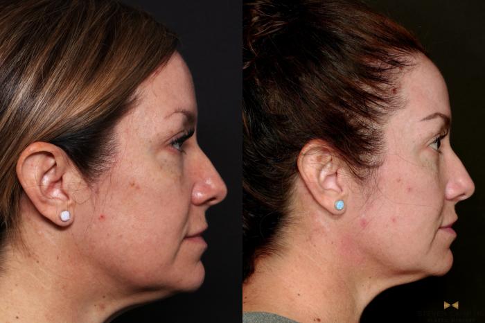 Before & After Sciton Laser Case 744 Right Side View in Fort Worth & Arlington, Texas