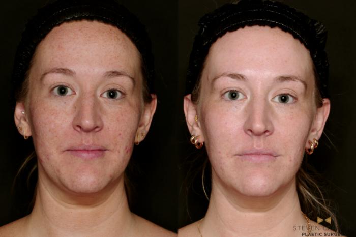 Before & After Sciton Laser Case 751 Front View in Fort Worth & Arlington, Texas