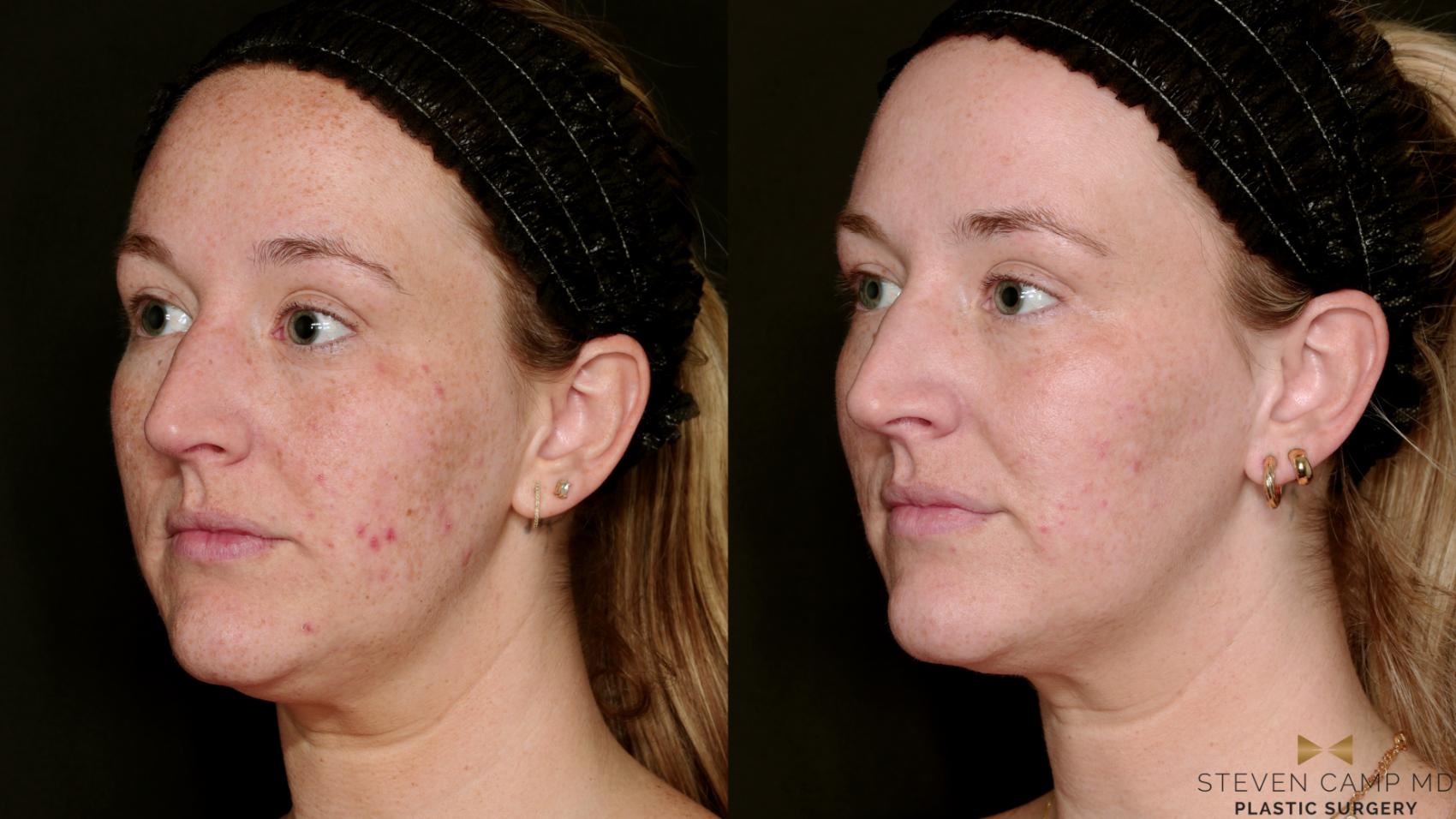 Before & After Sciton Laser Case 751 Left Oblique View in Fort Worth & Arlington, Texas