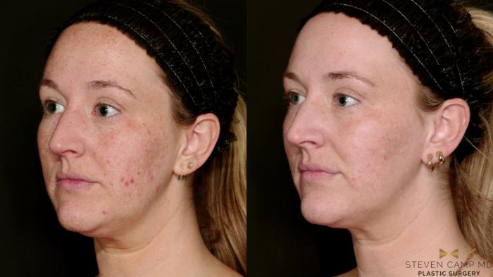 Before & After Sciton Laser Case 751 Left Oblique View in Fort Worth & Arlington, Texas