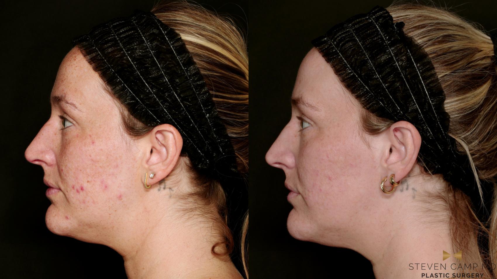 Before & After Sciton Laser Case 751 Left Side View in Fort Worth & Arlington, Texas