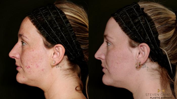 Before & After Sciton Laser Case 751 Left Side View in Fort Worth & Arlington, Texas