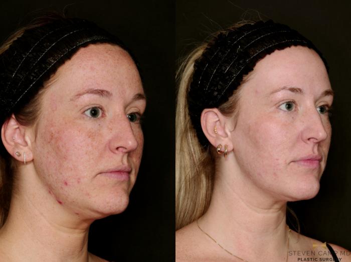 Before & After Sciton Laser Case 751 Right Oblique View in Fort Worth & Arlington, Texas