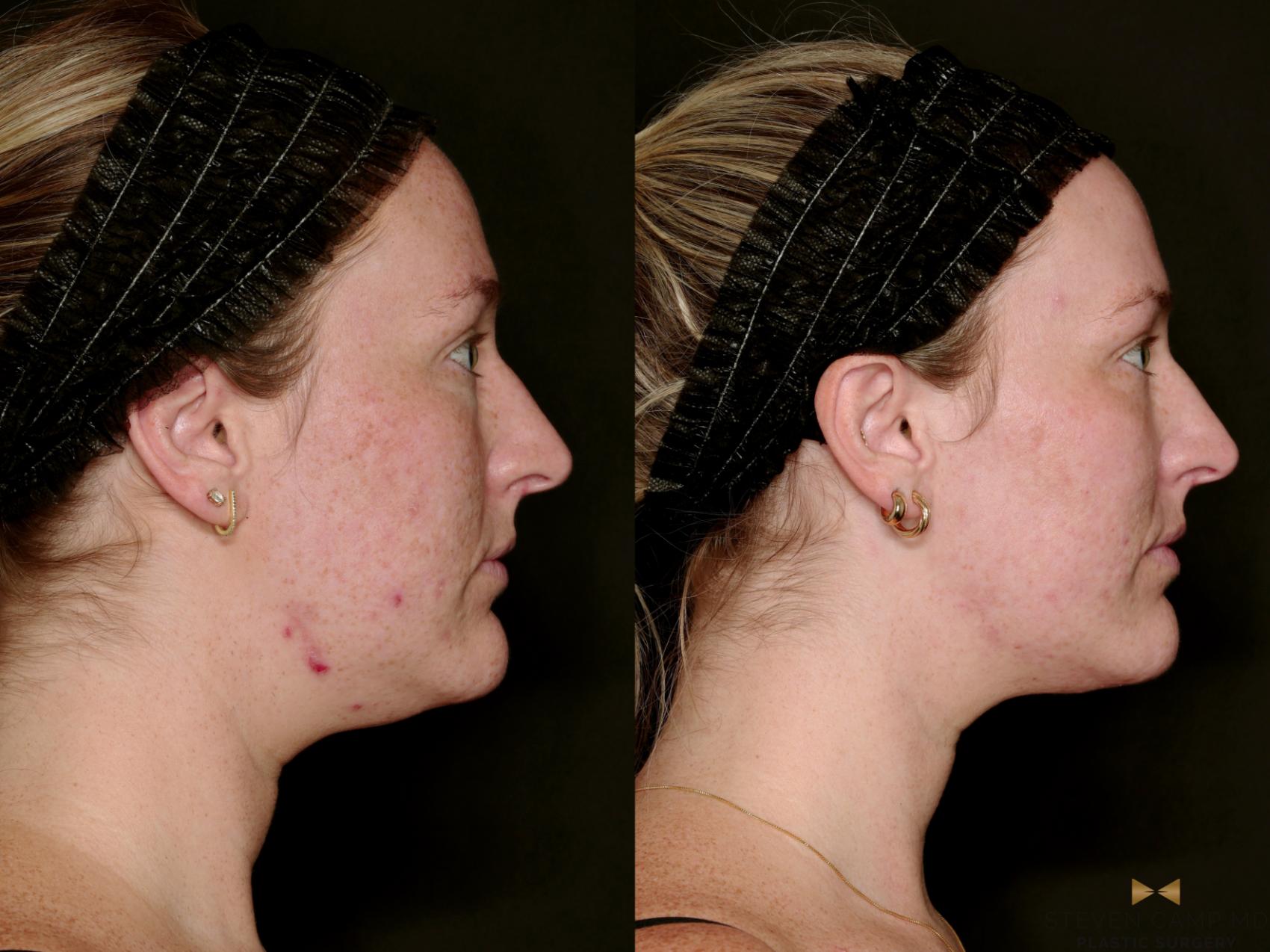 Before & After Sciton Laser Case 751 Right Side View in Fort Worth & Arlington, Texas