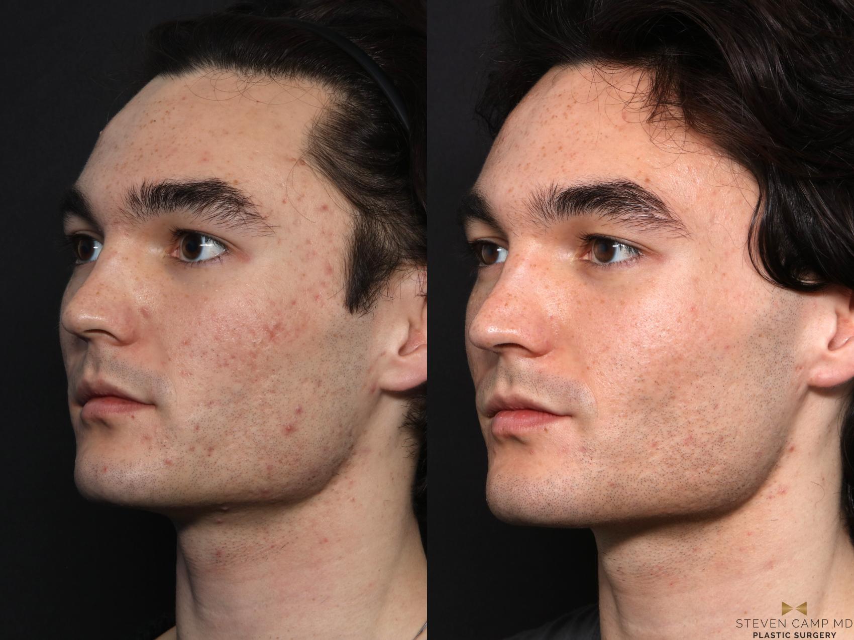 Before & After SkinPen Case 731 Left Oblique View in Fort Worth & Arlington, Texas