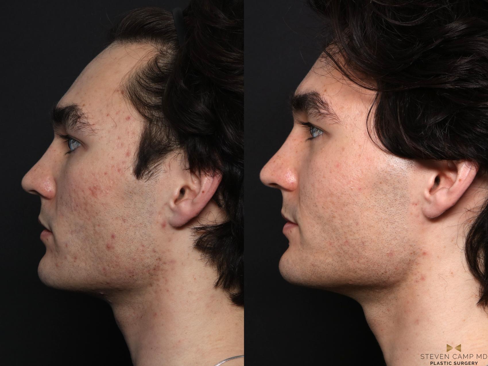 Before & After SkinPen Case 731 Left Side View in Fort Worth & Arlington, Texas