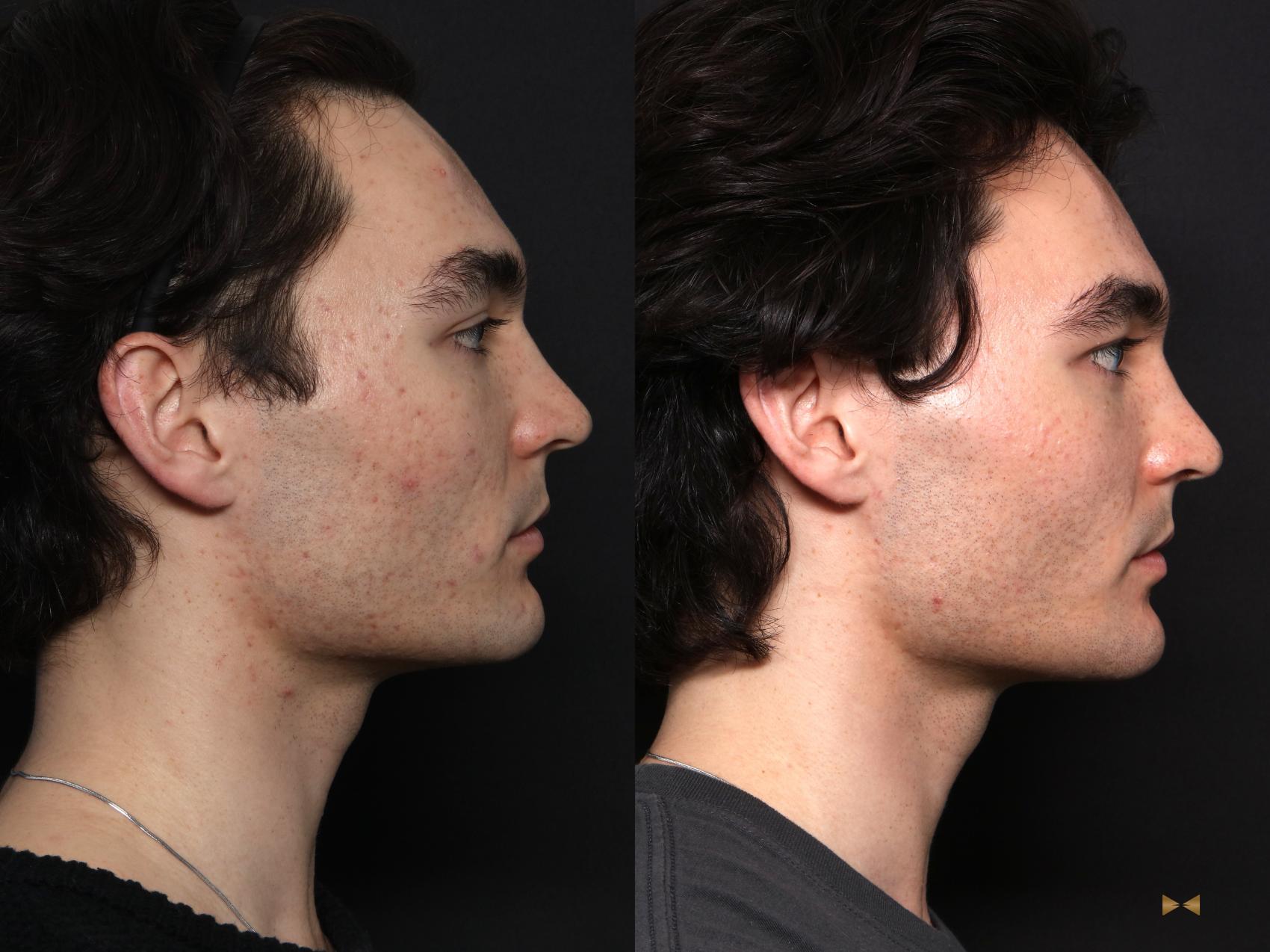 Before & After SkinPen Case 731 Right Side View in Fort Worth & Arlington, Texas