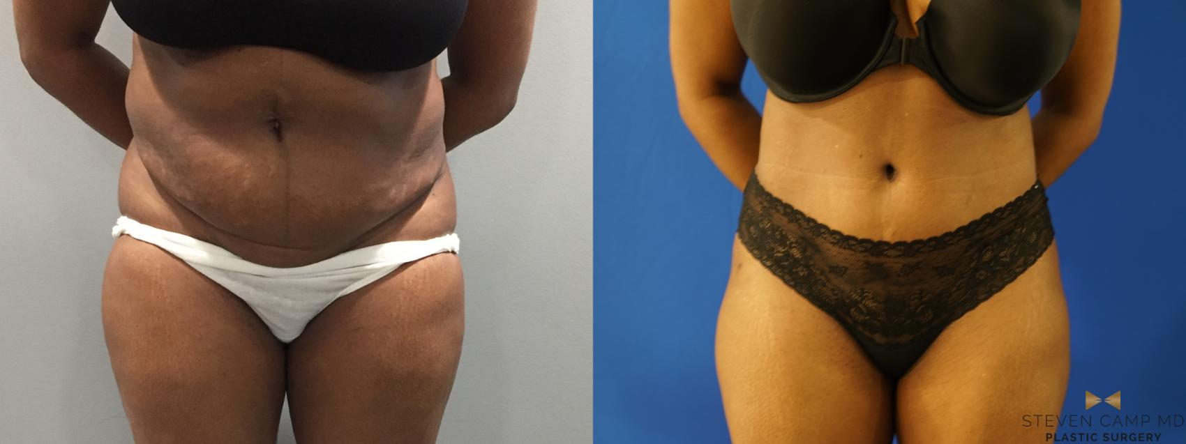 Before & After Tummy Tuck Case 107 View #1 View in Fort Worth, Texas