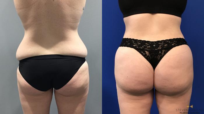 Before & After Liposuction Case 122 View #1 View in Fort Worth & Arlington, Texas