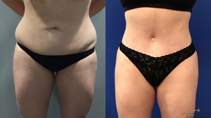 Before & After Brazilian Butt Lift Case 122 View #2 View in Fort Worth & Arlington, Texas