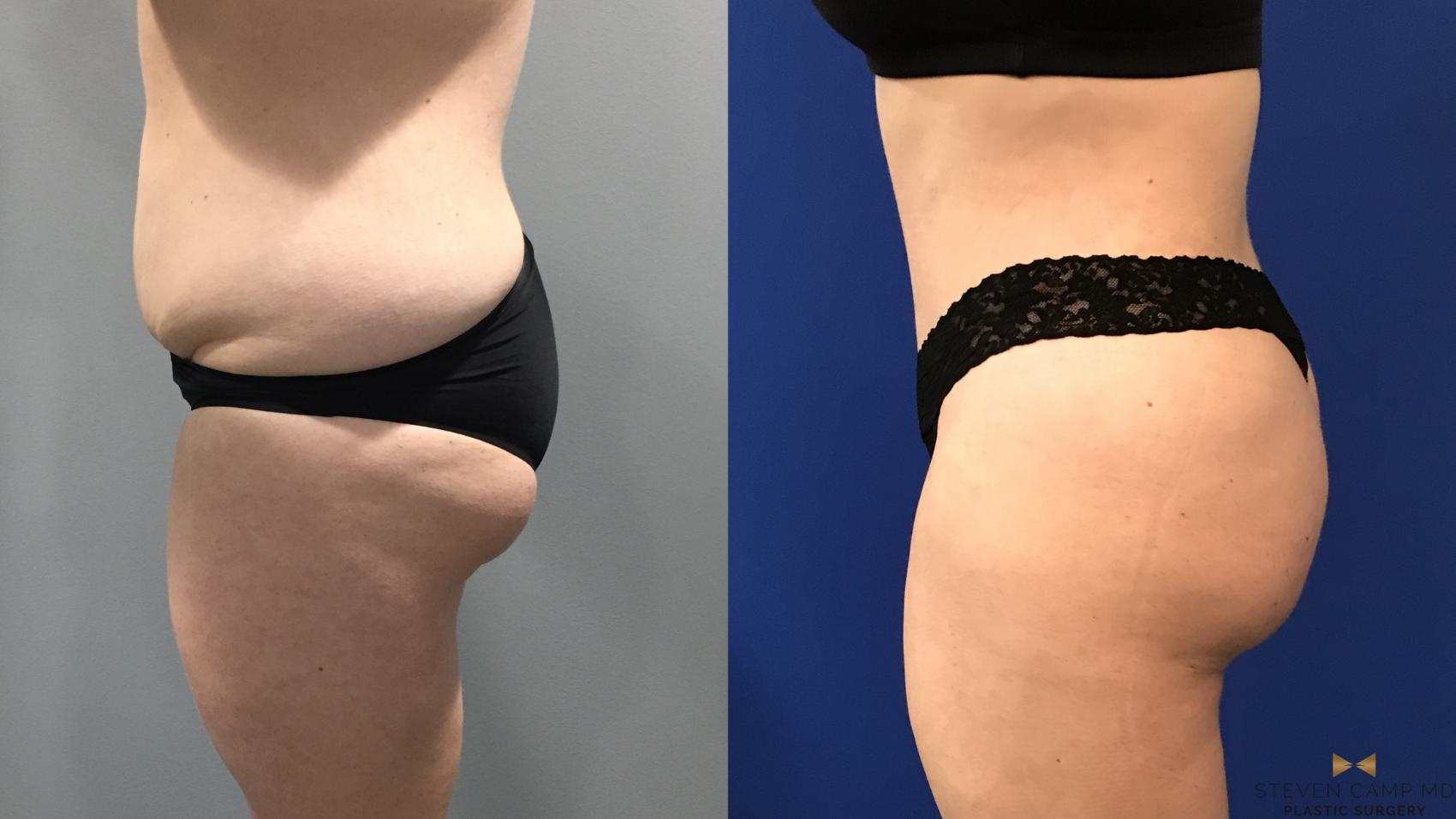 Before & After Tummy Tuck Case 122 View #3 View in Fort Worth & Arlington, Texas