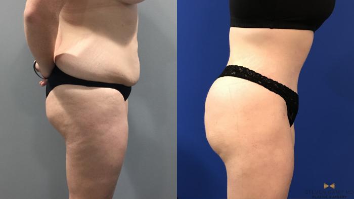Before & After Tummy Tuck Case 122 View #4 View in Fort Worth & Arlington, Texas