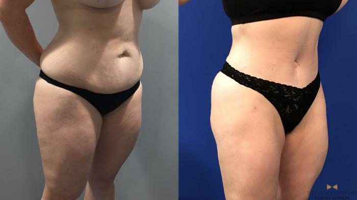Before & After Tummy Tuck Case 122 View #5 View in Fort Worth & Arlington, Texas