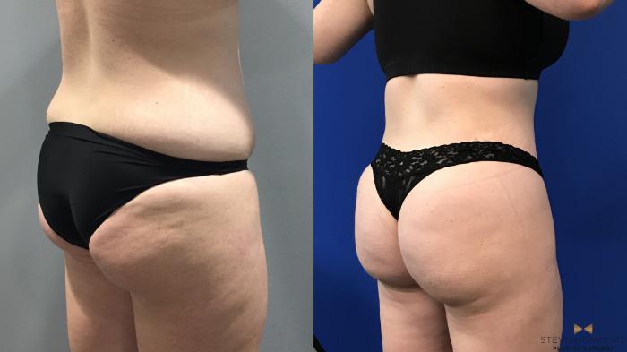 Before & After Tummy Tuck Case 122 View #6 View in Fort Worth & Arlington, Texas