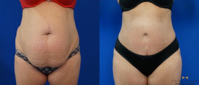Before & After Tummy Tuck Case 160 View #1 View in Fort Worth & Arlington, Texas