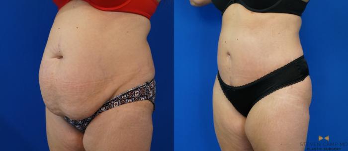 Before & After Tummy Tuck Case 160 View #2 View in Fort Worth & Arlington, Texas
