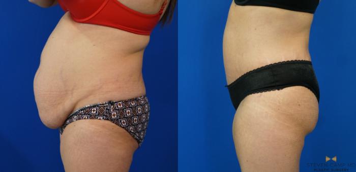 Before & After Tummy Tuck Case 160 View #3 View in Fort Worth & Arlington, Texas