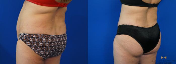 Before & After Tummy Tuck Case 160 View #4 View in Fort Worth & Arlington, Texas