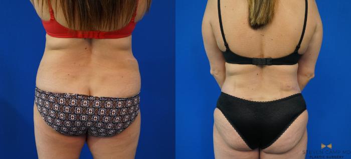 Before & After Tummy Tuck Case 160 View #5 View in Fort Worth & Arlington, Texas