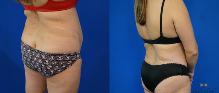 Before & After Tummy Tuck Case 160 View #6 View in Fort Worth & Arlington, Texas