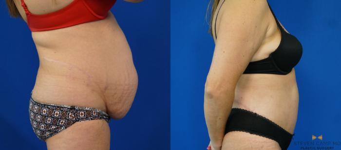 Before & After Tummy Tuck Case 160 View #7 View in Fort Worth & Arlington, Texas