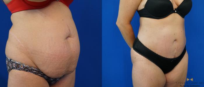 Before & After Tummy Tuck Case 160 View #8 View in Fort Worth & Arlington, Texas