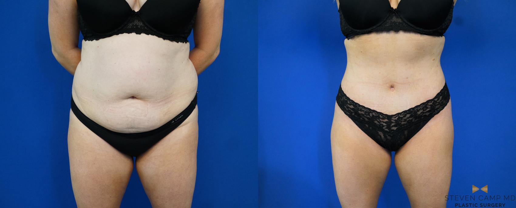 Before & After Tummy Tuck Case 172 View #1 View in Fort Worth & Arlington, Texas