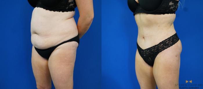 Before & After Tummy Tuck Case 172 View #2 View in Fort Worth & Arlington, Texas