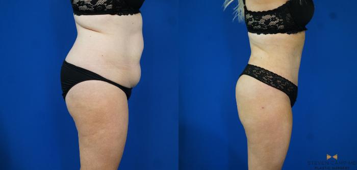 Before & After Tummy Tuck Case 172 View #4 View in Fort Worth & Arlington, Texas