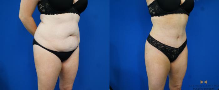 Before & After Tummy Tuck Case 172 View #5 View in Fort Worth & Arlington, Texas