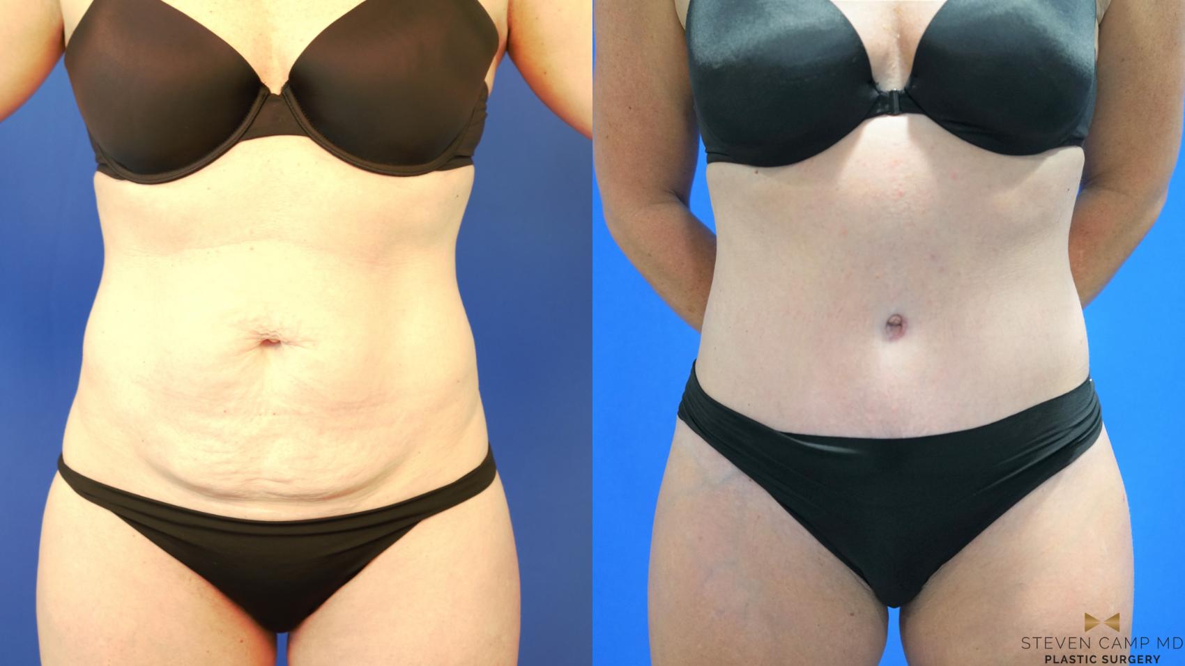 Before & After Tummy Tuck Case 187 View #1 View in Fort Worth, Texas