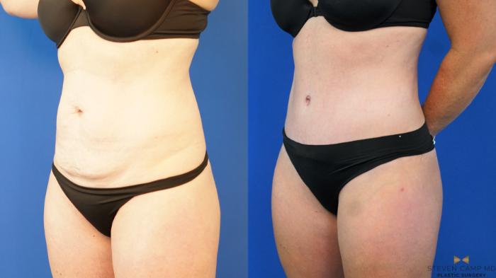 Before & After Liposuction Case 187 View #2 View in Fort Worth & Arlington, Texas
