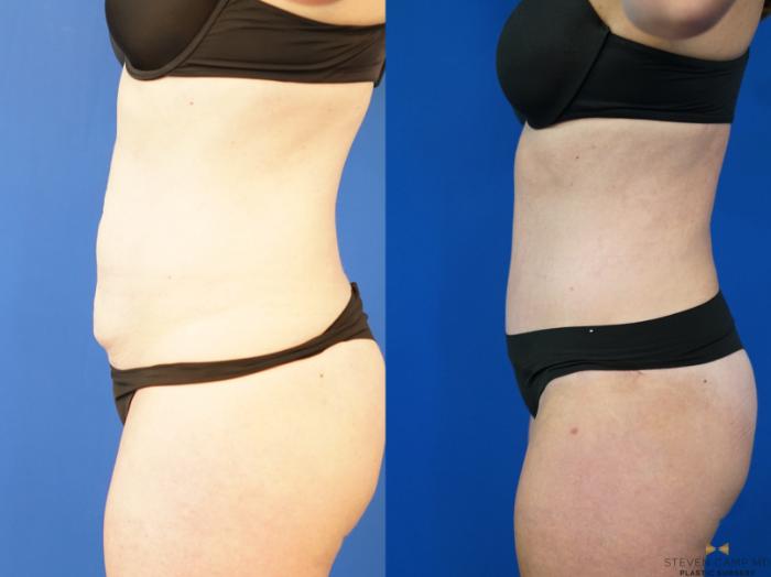 Before & After Liposuction Case 187 View #3 View in Fort Worth & Arlington, Texas